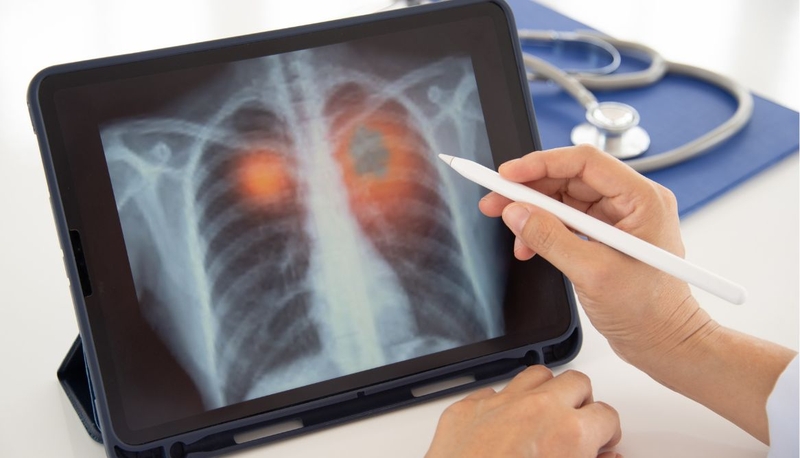 "Giải mã" hình ảnh viêm phổi ở trẻ em theo từng nguyên nhân 2