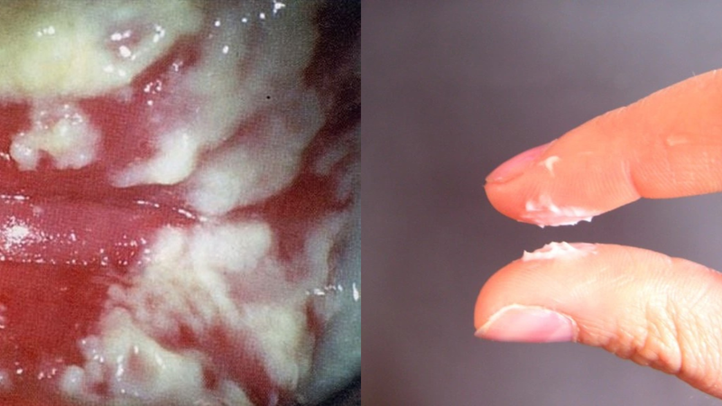 Hình ảnh viêm phụ khoa ở nữ và cách phòng ngừa 12