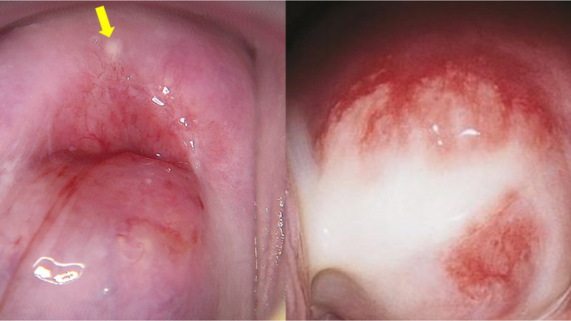 Hình ảnh viêm phụ khoa ở nữ và cách phòng ngừa 13