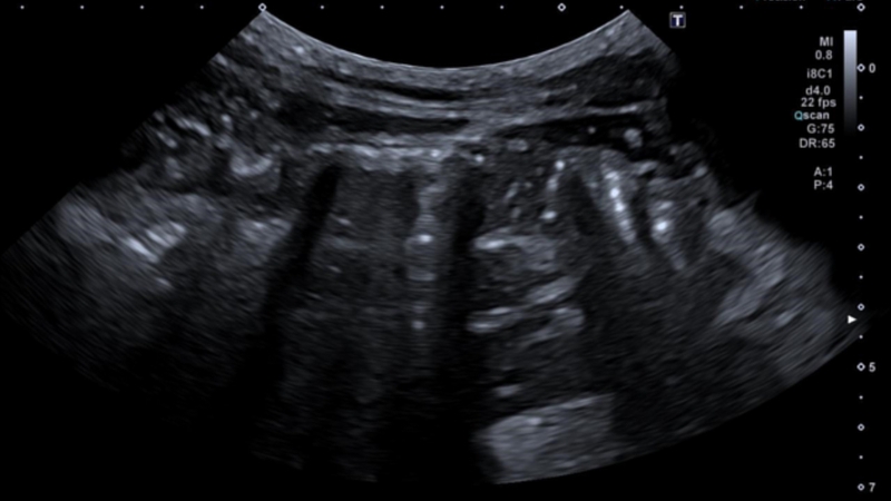 Hình ảnh viêm ruột thừa cấp trên siêu âm như thế nào? 3