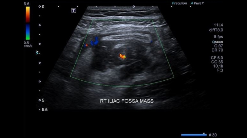 Hình ảnh viêm ruột thừa cấp trên siêu âm như thế nào? 4