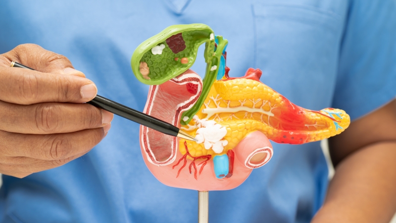 Hình ảnh viêm tụy cấp trên CT và những điều bạn cần biết 1