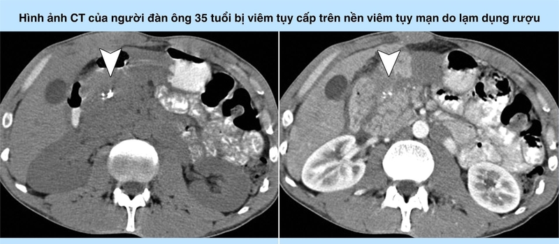 Hình ảnh viêm tụy cấp trên CT và những điều bạn cần biết 3