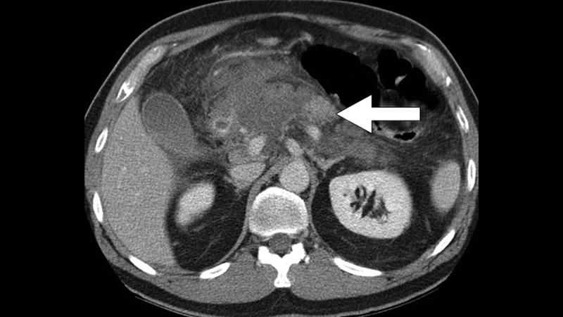 Hình ảnh viêm tụy cấp trên CT và những điều bạn cần biết 4