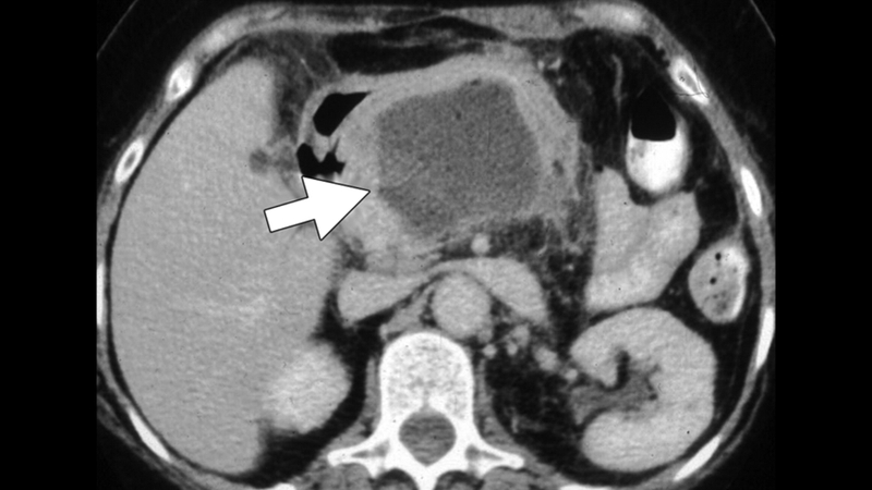 Hình ảnh viêm tụy cấp trên CT và những điều bạn cần biết 5