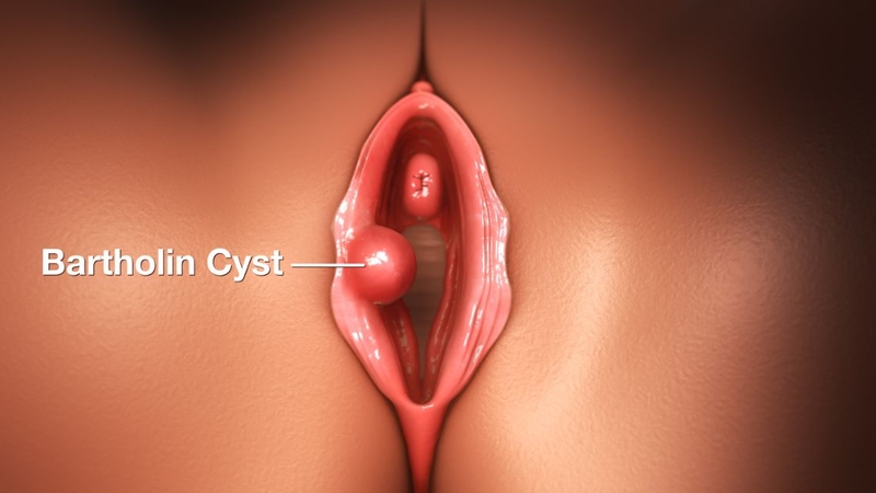 Viêm tuyến Bartholin&nbsp;thường gặp ở phụ nữ trong độ tuổi sinh sản