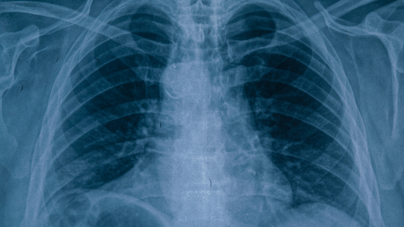 Hình ảnh X-quang viêm phế quản như thế nào? 3