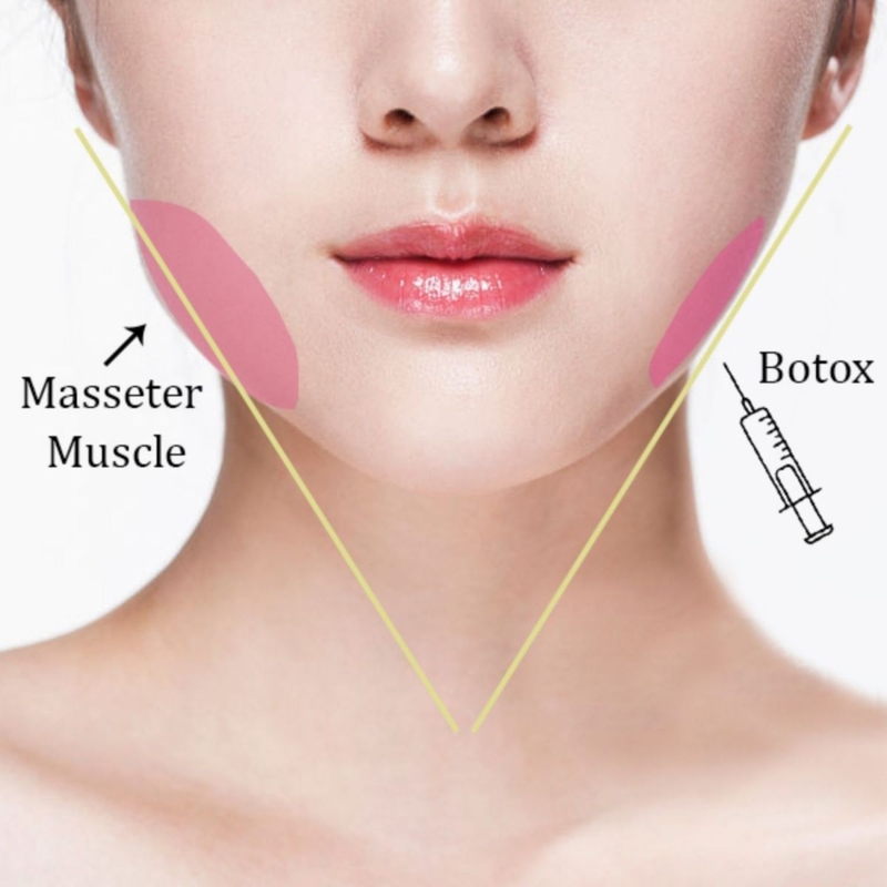 Tiêm botox gọn hàm bao nhiêu cc? Tiêm botox bao lâu có hiệu quả? 1