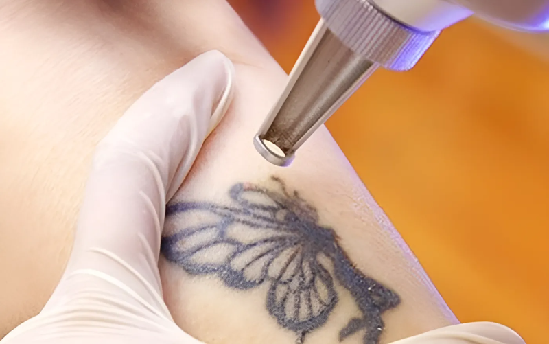 Hình xăm bị nổ mực là gì? Có cách nào khắc phục nó hay không? 3