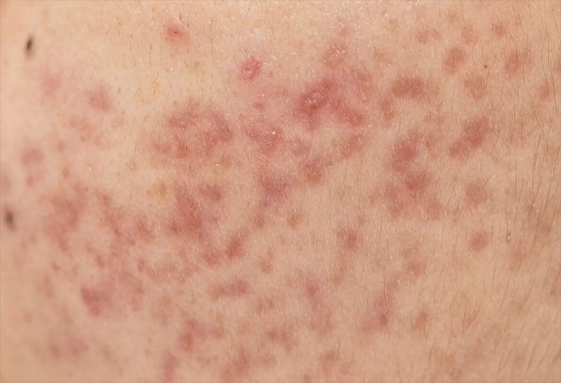 Hiruscar có trị sẹo thâm không và nên dùng dòng sản phẩm nào? 1