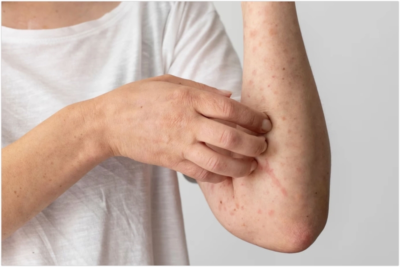 Histamin có trong thực phẩm nào? Cần lưu ý gì khi dùng thực phẩm này 4