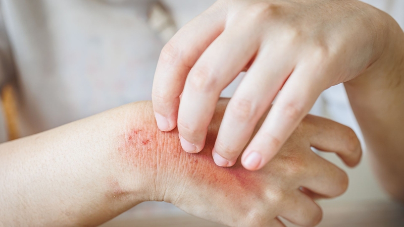 Dị ứng và histamin trong cơ thể có mối liên hệ chặt chẽ với nhau