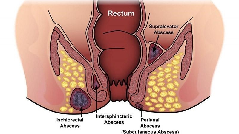 hau-mon-co-mui-hoi-nguyen-nhan-va-cach-khac-phuc 2