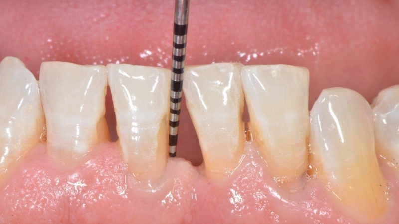 Hở chân răng là gì? Nguyên nhân và các phương pháp điều trị 1