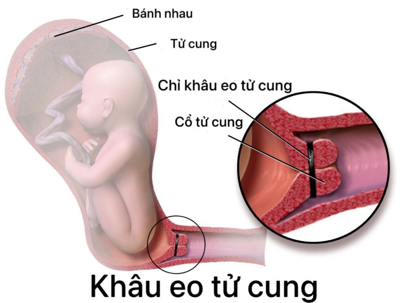 Hở eo tử cung: Nguyên nhân, triệu chứng, phương pháp điều trị và cách phòng ngừa 4