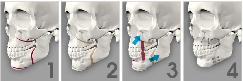 Hô hàm dưới: Nguyên nhân, tác hại và phương hướng khắc phục 4