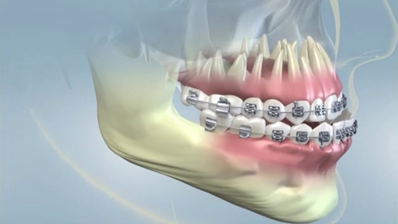 Hô hàm dưới: Nguyên nhân, tác hại và phương hướng khắc phục 6