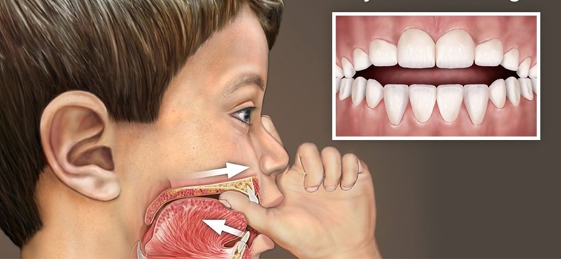 Hô hàm trên: Nguyên nhân, biểu hiện và cách khắc phục 2