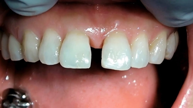 Hở kẽ răng cửa: Nguyên nhân, tác hại và cách xử trí mà bạn cần biết 1