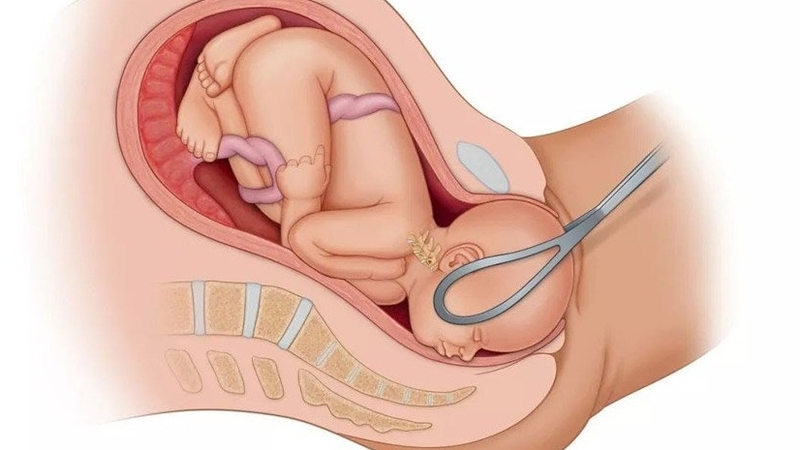 Thủ thuật hỗ trợ sinh khó và những rủi ro có thể gặp phải 2