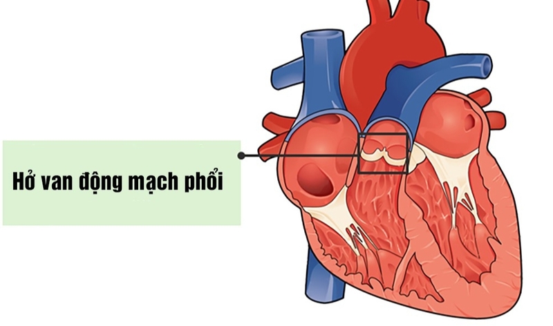 Hở van động mạch phổi: Nguyên nhân, triệu chứng, cách chẩn đoán và điều trị 1