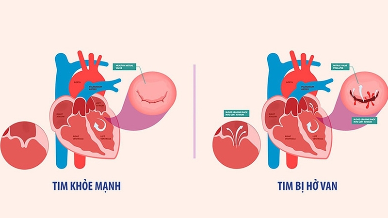 Hở van tim có di truyền không? Biết để phòng ngừa hiệu quả 3