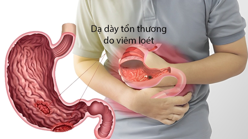 hoa-du-du-duc-chua-viem-loet-da-day-1.jpg