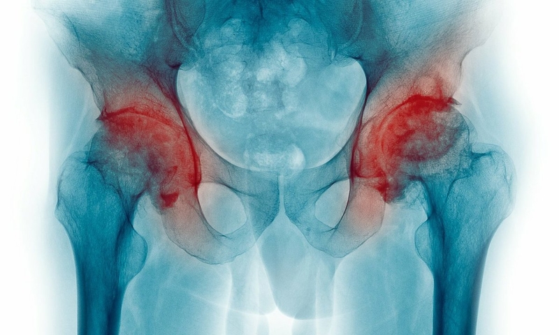 Hoại tử chỏm xương đùi: Những thông tin cần biết 1