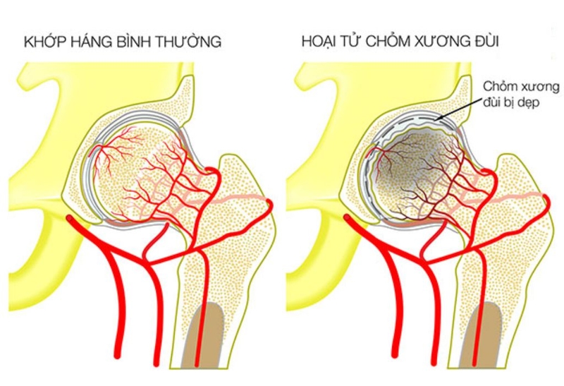 Hoại tử chỏm xương đùi: Những thông tin cần biết 2