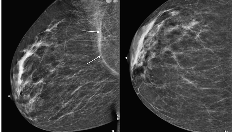 hoại tử mỡ mô vú ảnh hưởng như thế nào