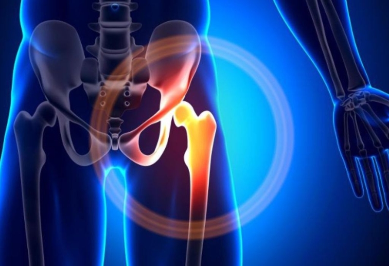Hoại tử vô khuẩn chỏm xương đùi: Căn bệnh rất nguy hiểm 1