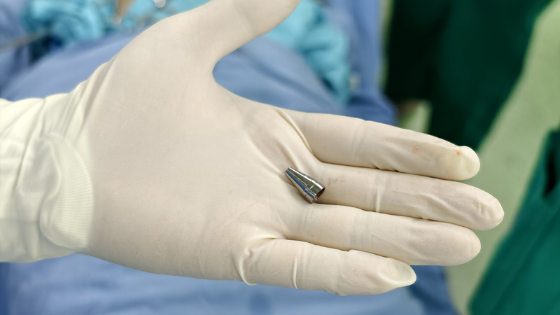 Dị vật là đầu ngòi bút được lấy ra khỏi phế quản trẻ