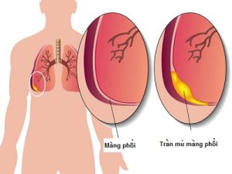 Hội chứng 3 giảm trong tràn khí màng phổi là gì? Có nguy hiểm không? 3