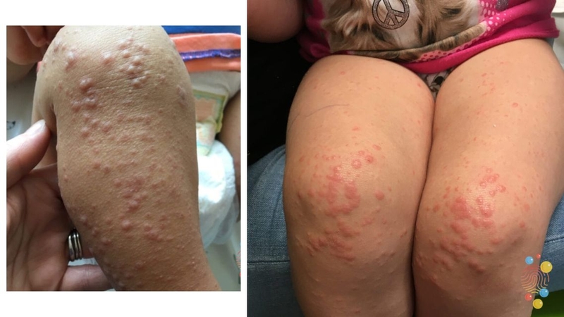 Hội chứng Gianotti Crosti: Bệnh lý về da hiếm gặp ở trẻ em cha mẹ cần biết 3