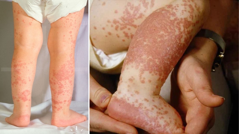Hội chứng Gianotti Crosti: Bệnh lý về da hiếm gặp ở trẻ em cha mẹ cần biết 2