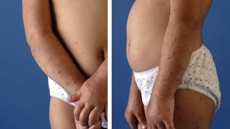 Hội chứng Gianotti Crosti: Bệnh lý về da hiếm gặp ở trẻ em cha mẹ cần biết 4