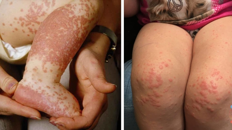 Hội chứng Gianotti Crosti: Bệnh lý về da hiếm gặp ở trẻ em cha mẹ cần biết 1