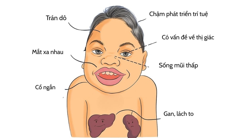 Hội chứng Hurler: Nguyên nhân, dấu hiệu nhận biết và cách điều trị hiệu quả 3