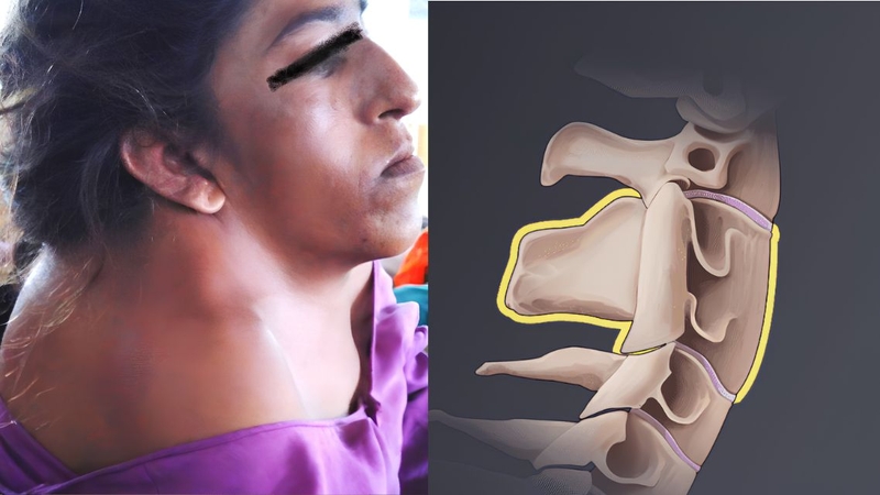 Biểu hiện bên ngoài của hội chứng Klippel-Feil không phải lúc nào cũng rõ ràng
