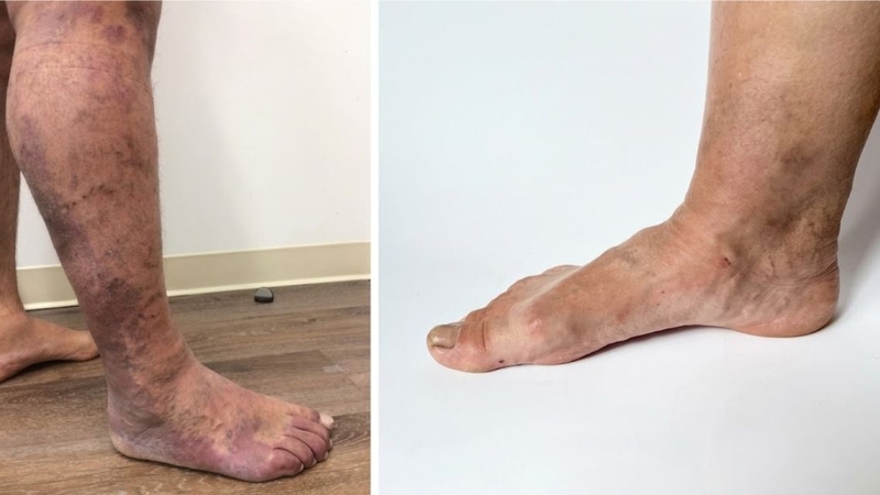 Một chi phát triển quá mức có thể ảnh hưởng đến khả năng vận động