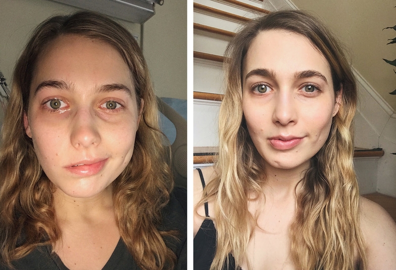 Hội chứng Ramsay Hunt: Nguyên nhân, triệu chứng và cách điều trị 2