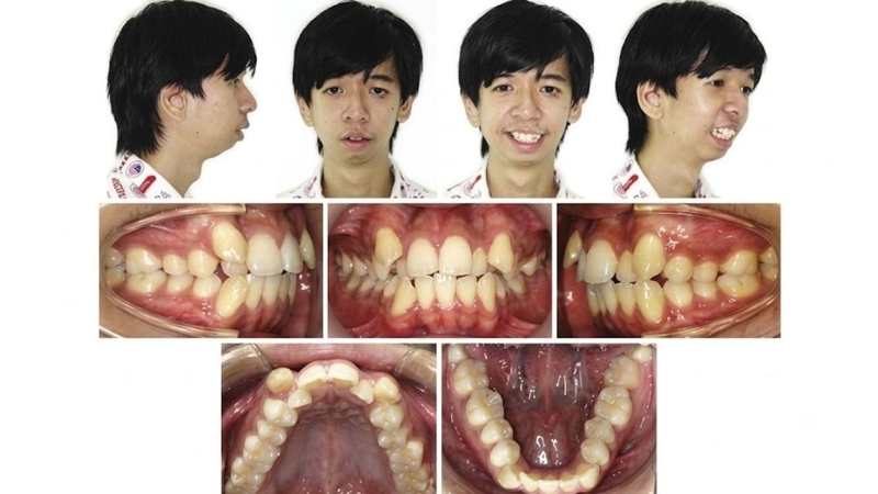 Hàm dưới nhỏ có thể gây khó thở và ảnh hưởng đến khả năng ăn uống ở người bệnh