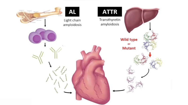 Hội chứng Abercrombie: Triệu chứng, nguyên nhân và cách điều trị 5