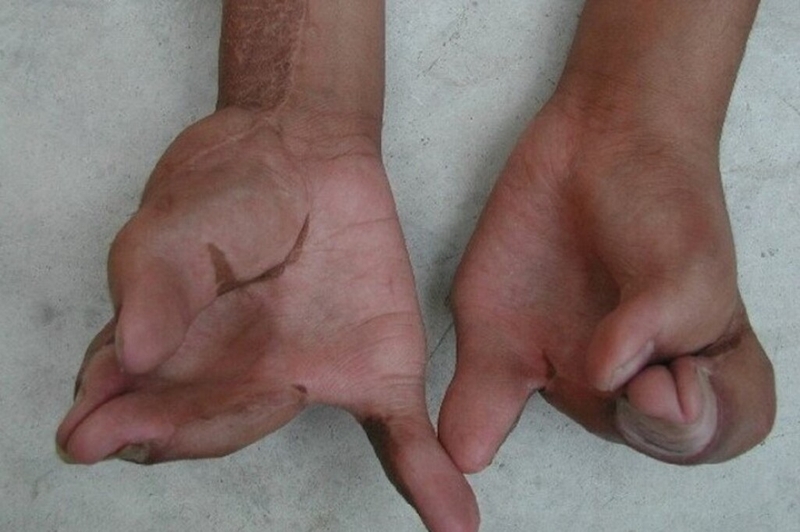 Hội chứng apert là gì? Những nguyên nhân và dấu hiệu nhận biết của hội chứng apert 3