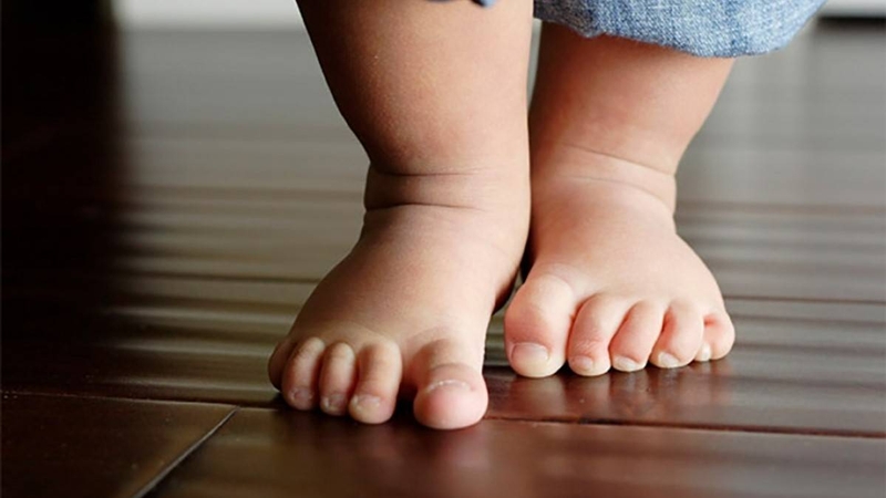 bàn chân bẹt không gây đau nhưng nếu khung xương không đủ vững chắc để chống đỡ mất cân bằng
