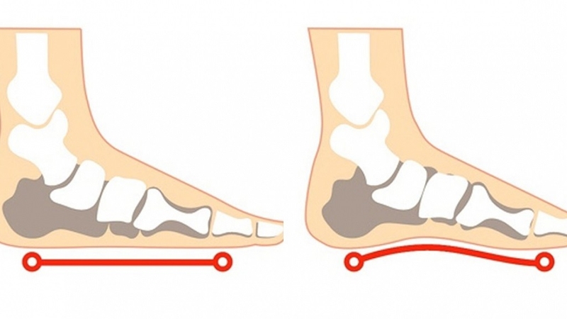 Phát hiện sớm điều trị bằng miếng lót chỉnh hình y tế là một giải pháp đơn giản và hiệu quả để điều chỉnh bàn chân bẹt ở trẻ em