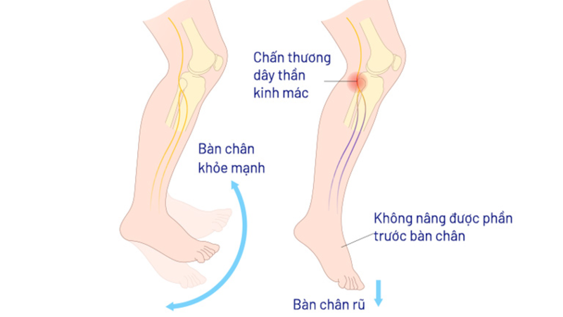 Hội chứng bàn chân rũ: Nguyên nhân, dấu hiệu và cách điều trị 1