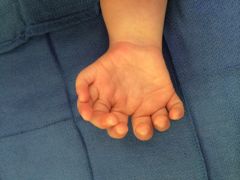 Hội chứng bàn tay gương là gì? Hội chứng này có di truyền không? 2