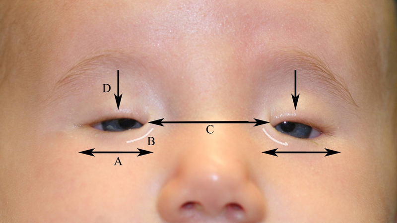 Hội chứng BPES: Hiểu rõ về đôi mắt và những ảnh hưởng 1