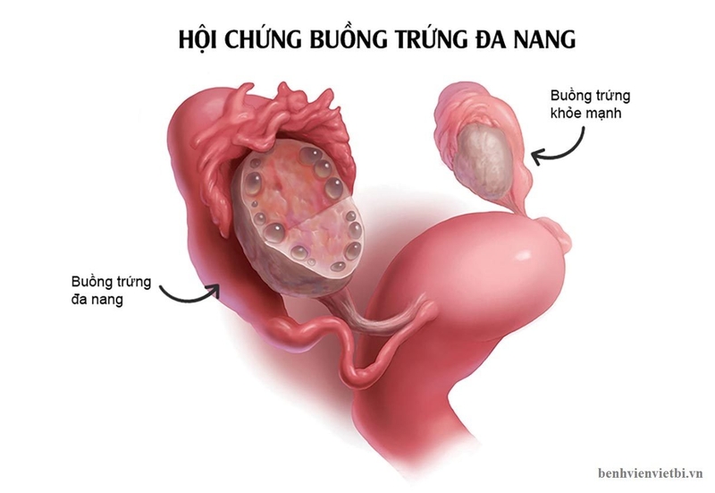 Nguyên nhân gây ra tình trạng rối loạn kinh nguyệt ở tuổi 17